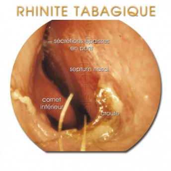 rhinite-tabagique-07