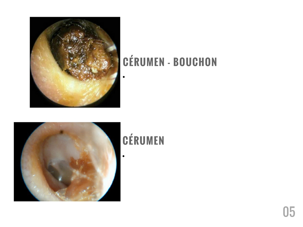 cerumen