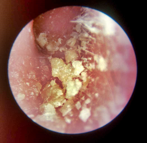 Eczema De L Oreille Que Faire Eczema De L Oreille Que Faire