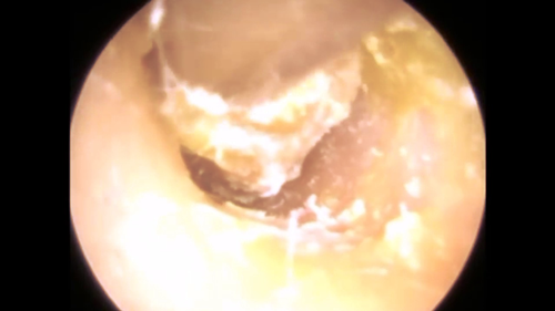 Eczema De L Oreille Que Faire Eczema De L Oreille Que Faire