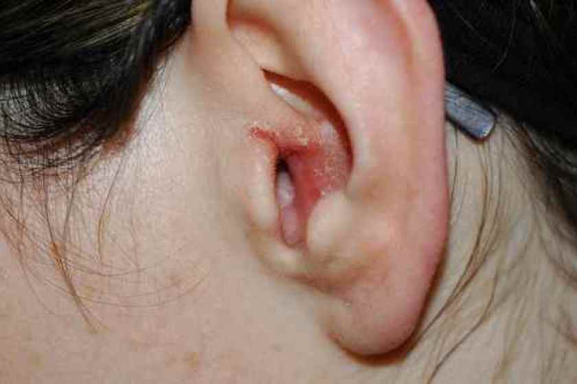 Conseils Pour Reduire Eczema Oreille Conseils Pour Reduire Eczema Oreille