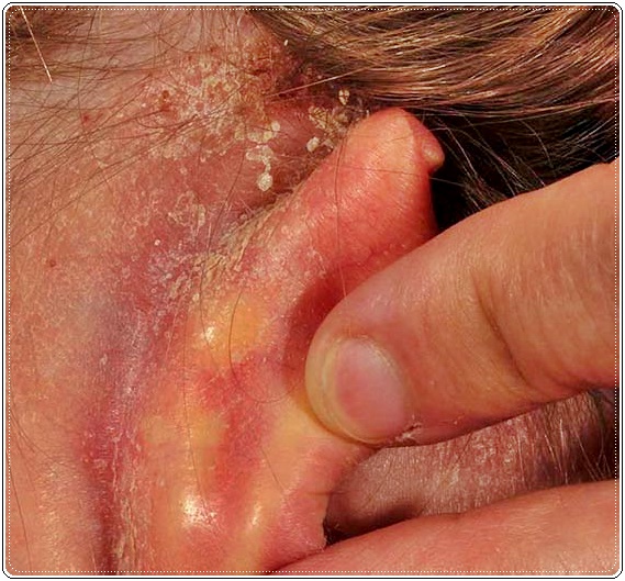 Eczema De L Oreille Les Meilleurs Conseils