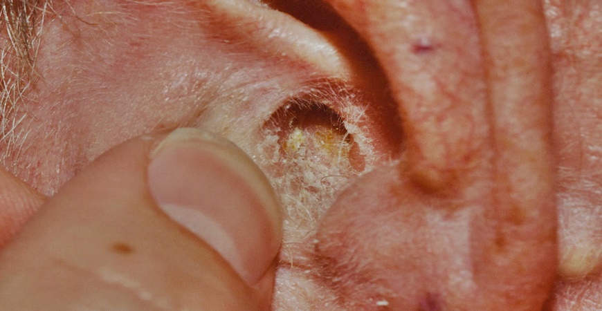 Eczema D Oreille