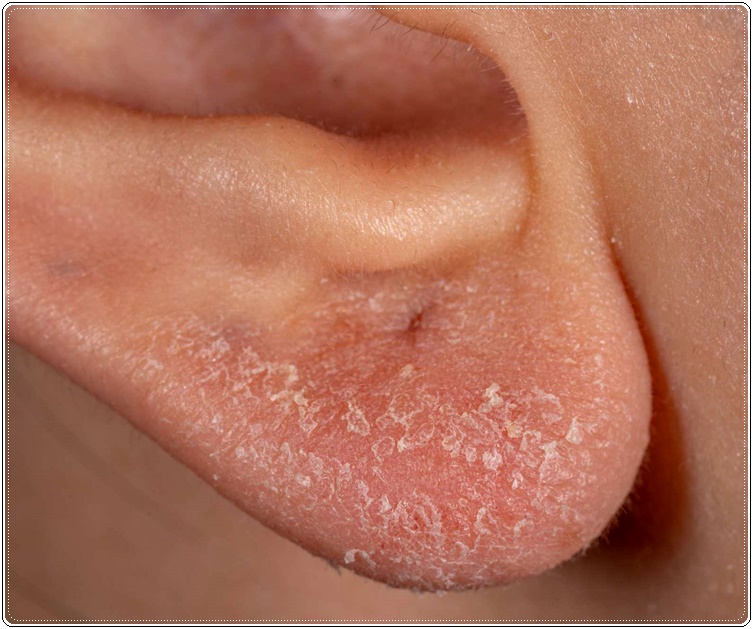 Eczema De L Oreille Les Meilleurs Conseils