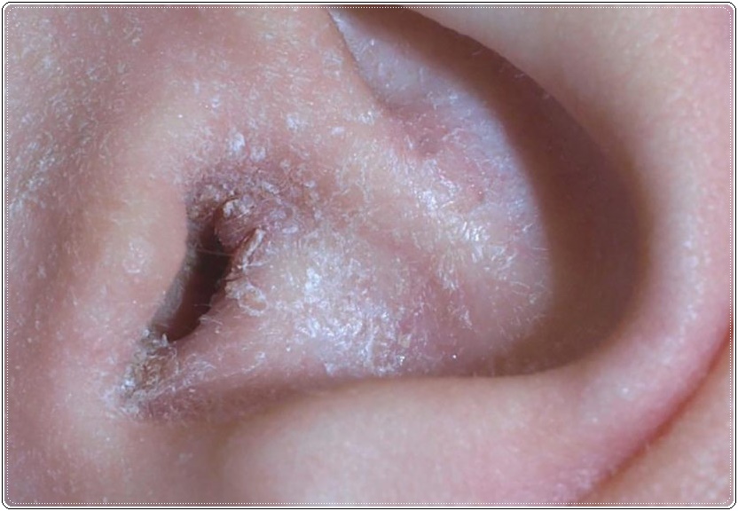 Eczema De L Oreille Les Meilleurs Conseils