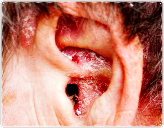 Eczema De L Oreille Les Meilleurs Conseils
