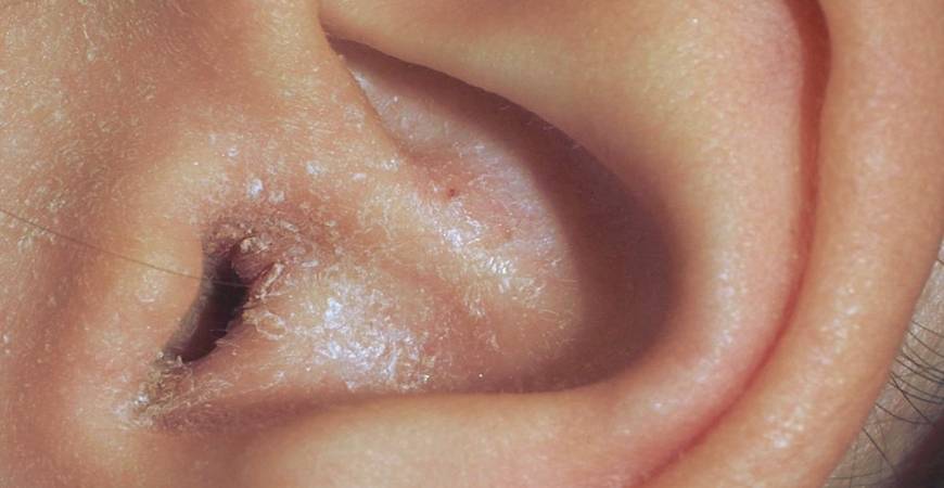 Eczema du conduit auditif : s'en débarasser naturellement...